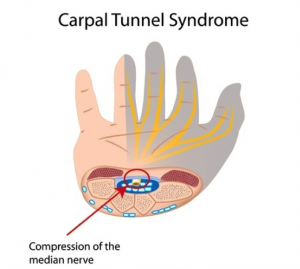 carpal-tunnel-release