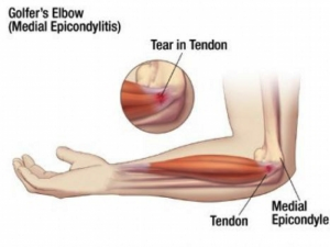 golfers-elbow-surgery