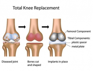 knee-replacement-2