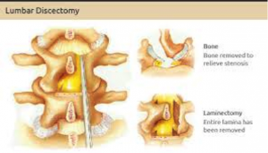 lumbar-discectomy