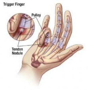 trigger-finger-release